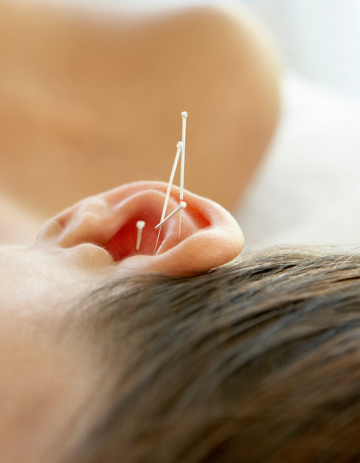 acupunture of the ear